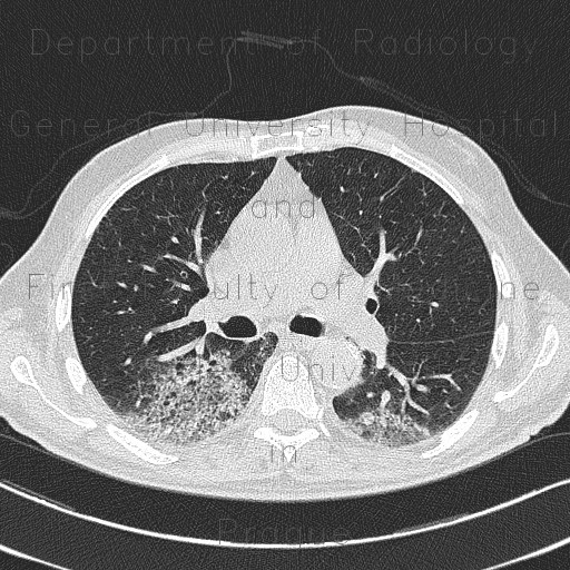 Radiology image - ANCA vasculitis, lung involvement: Thorax, Lung: CT - Computed tomography