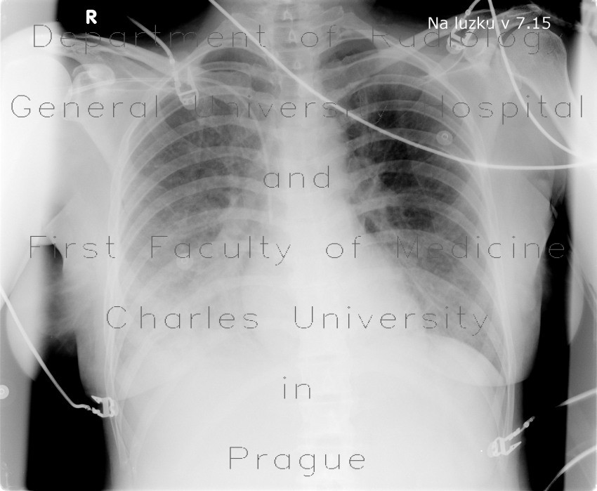 Radiology image - ARDS, interstitial edema: Thorax, Lung, Mediastinum and pleural cavity: X-ray - Plain radiograph