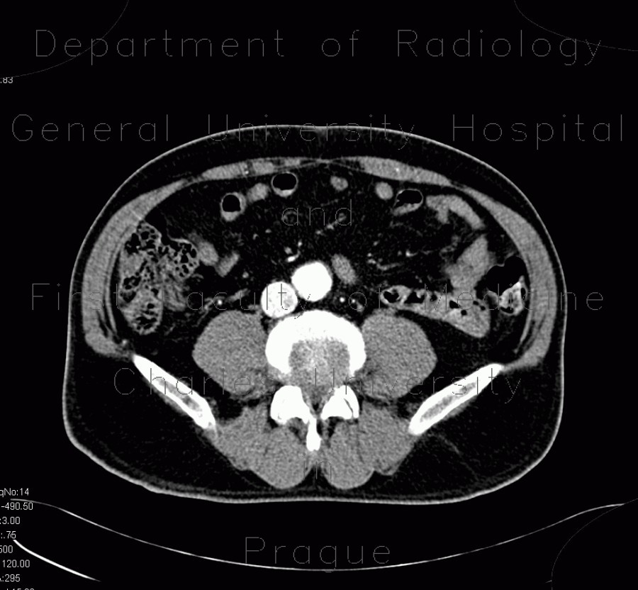 Radiology image - AV fistula, arteriovenous fistula in the leg: Abdomen, Extremity, Vessels: CT - Computed tomography
