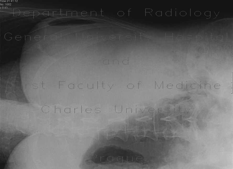 Abdomen radiograph, right decubitus, stomach bubble mimicking pneumoperitoneum