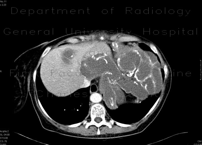 Radiology image - Abdominal sacroma: Abdomen, Peritoneal cavity: CT - Computed tomography