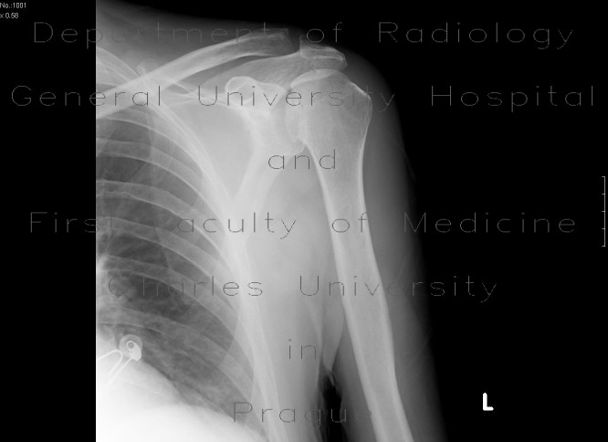 Abruption of articular surface of humeral head, osteonecrosis