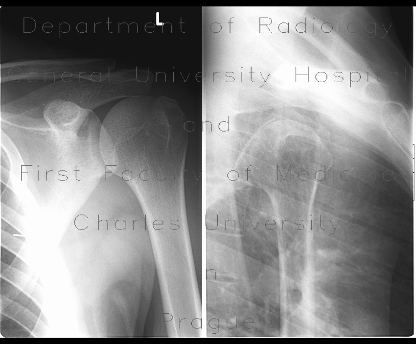 Abruption of the greater tubercle of humerus