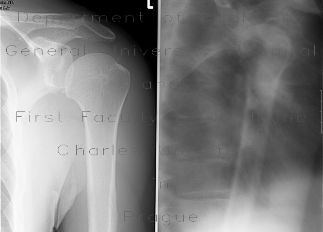 Radiology image - Abruption of the rim of glenoid: Extremity, Bone: X-ray - Plain radiograph