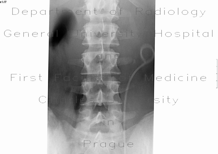 Abruption of transverse process of lumbar vertebra