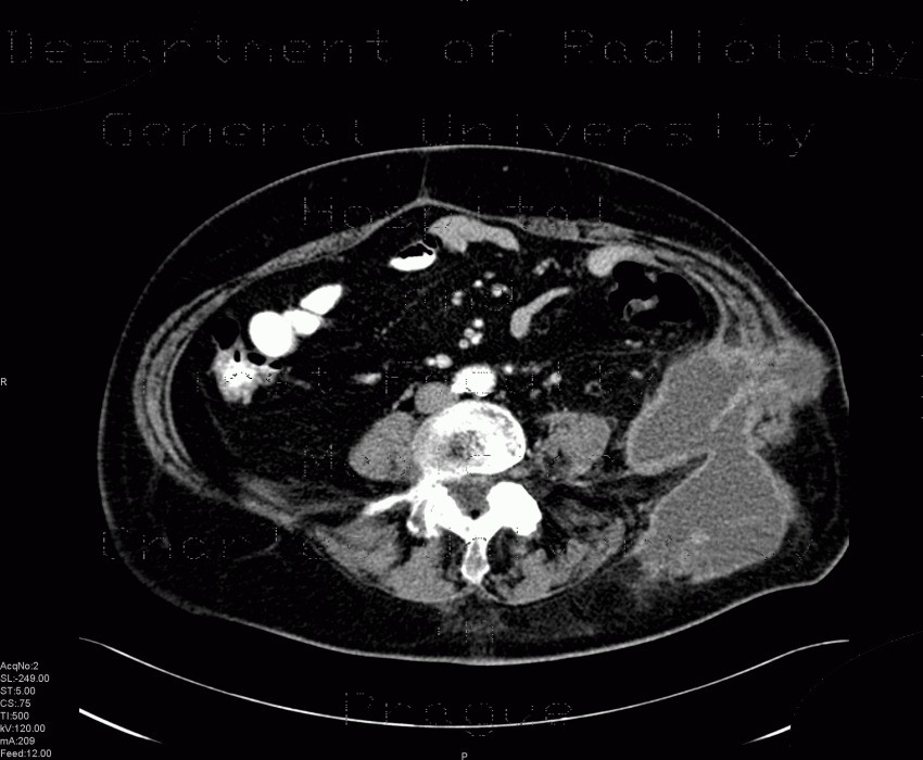 Radiology image - Abscess after diverticulitis, second CT: Abdomen, Peritoneal cavity: CT - Computed tomography