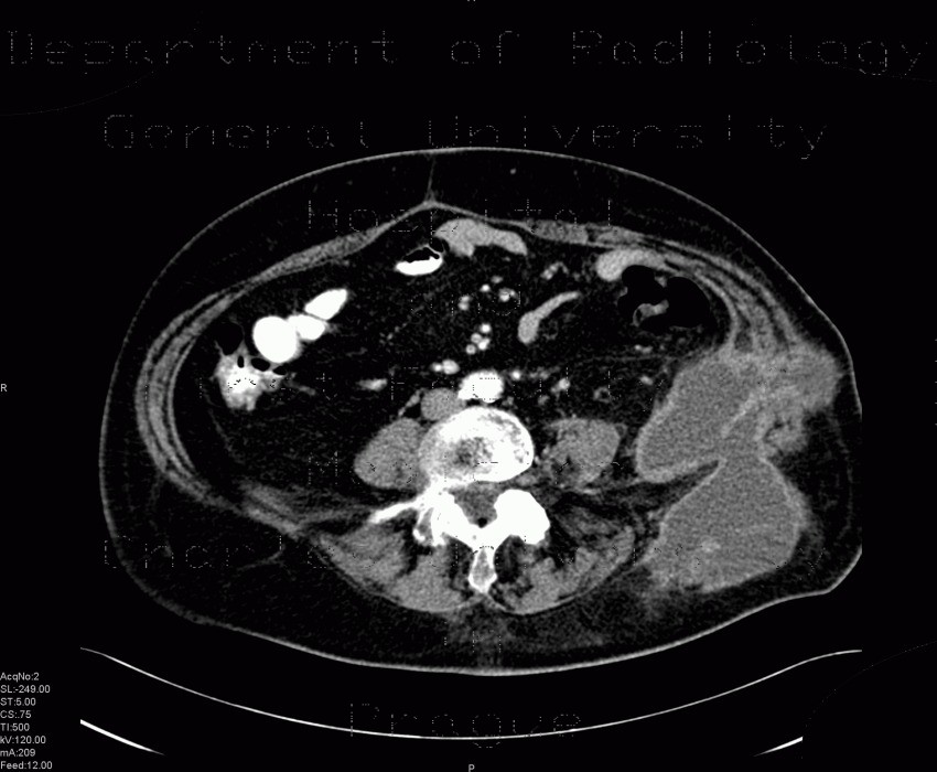 Abscess after diverticulitis, second CT