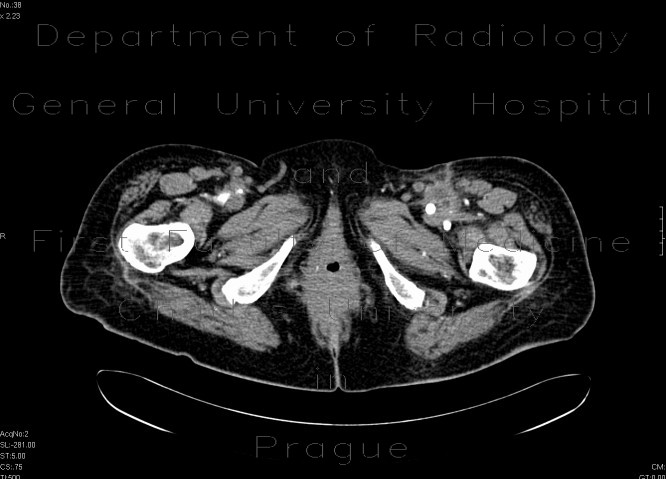 Radiology image - Abscess at the proximal anastomosis of aorto-femoral bypass: Extremity, Soft tissue, Vessels: CT - Computed tomography