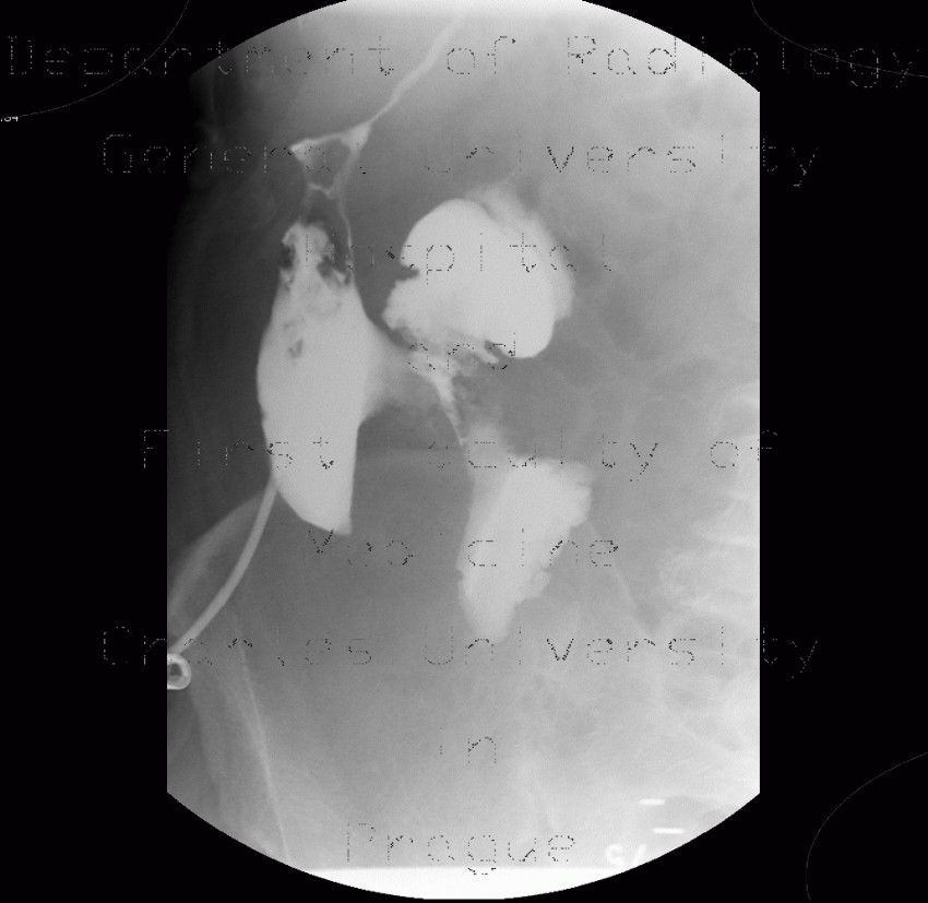 Radiology image - Abscess, cutaneous fistula, colonic fistula: Abdomen, Large bowel, Retroperitoneum, pelvis: RF - Fluoroscopy