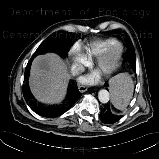 Abscess in liver, cholangoitis, maturation, first CT