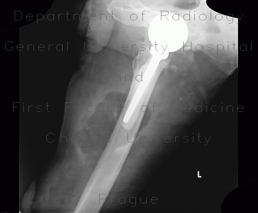 Abscess of thigh, perianal abscess