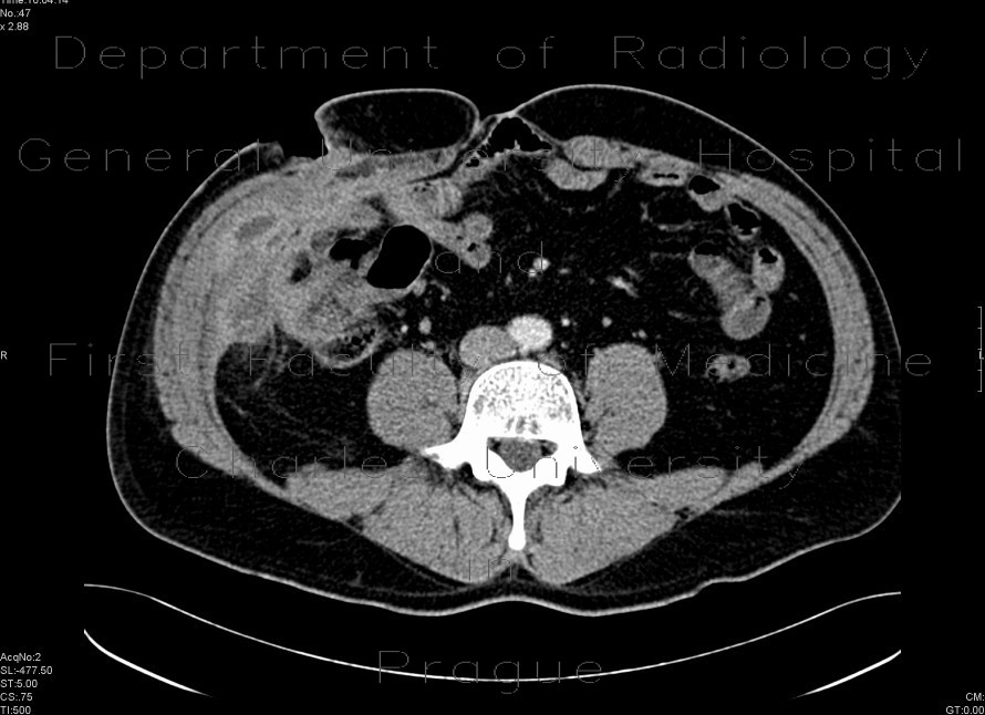 Abscesses in abdominal wall following appendectomy