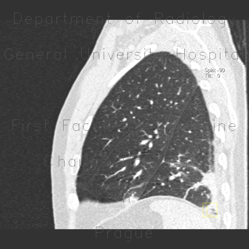 Accessory interlobium