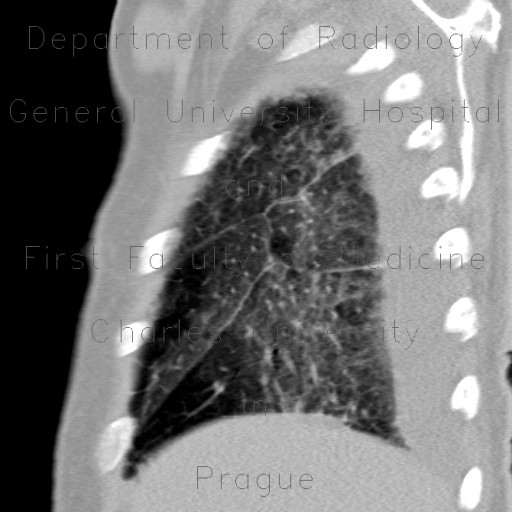 Radiology image - Accessory interlobium, pulmonary edema: Thorax, Lung, Mediastinum and pleural cavity: CT - Computed tomography