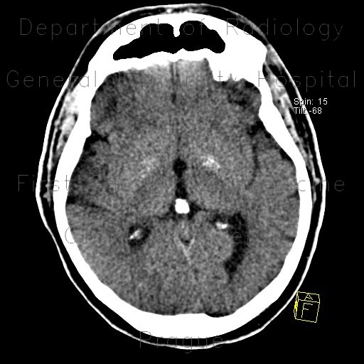 Radiology image - Accumulation of iron in the medial globus pallidus, globus pallidus internus: Brain, Brain: CT - Computed tomography