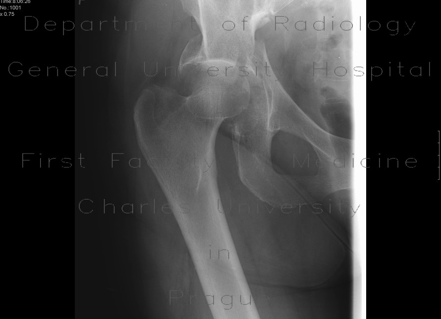 Acetabular fracture, posterior dislocation of the femoral head, dashboad injury