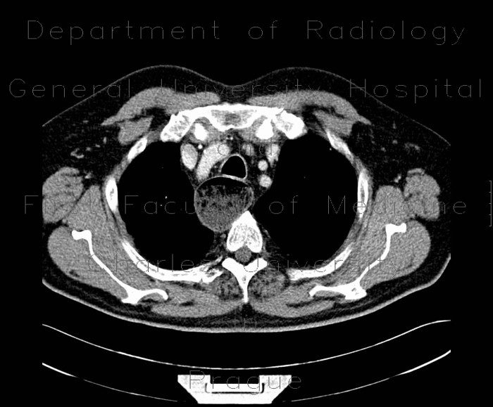 Radiology image - Achalasia: Thorax, Oesophagus: CT - Computed tomography
