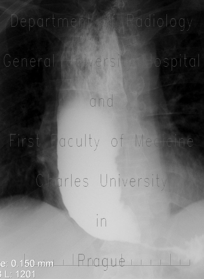 Radiology image - Achalasia of oesophagus: Thorax, Oesophagus: RF - Fluoroscopy