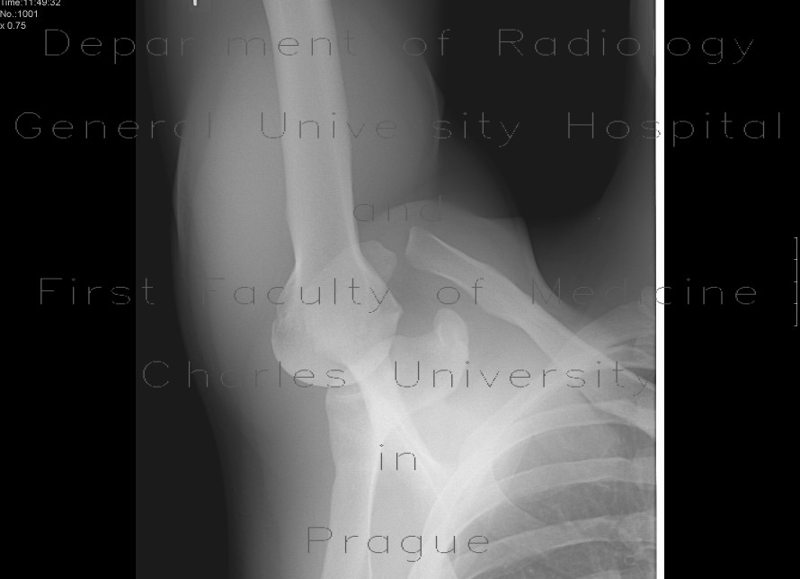 Acromioclavicular dislocation