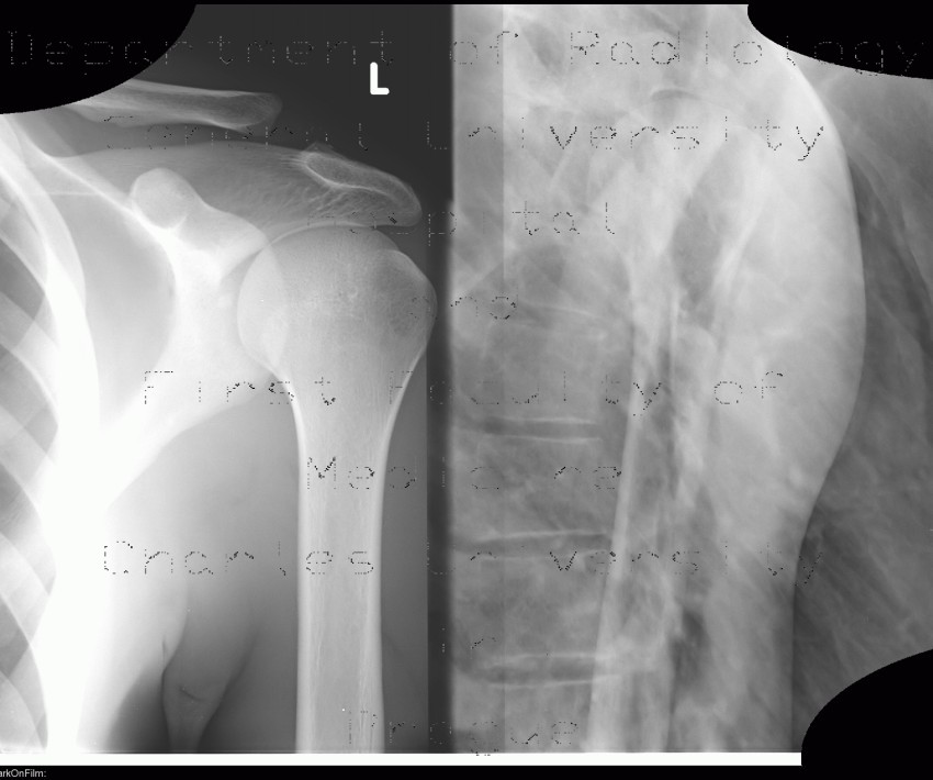 Radiology image - Acromioclavicular joint, separation: Extremity, Bone: X-ray - Plain radiograph