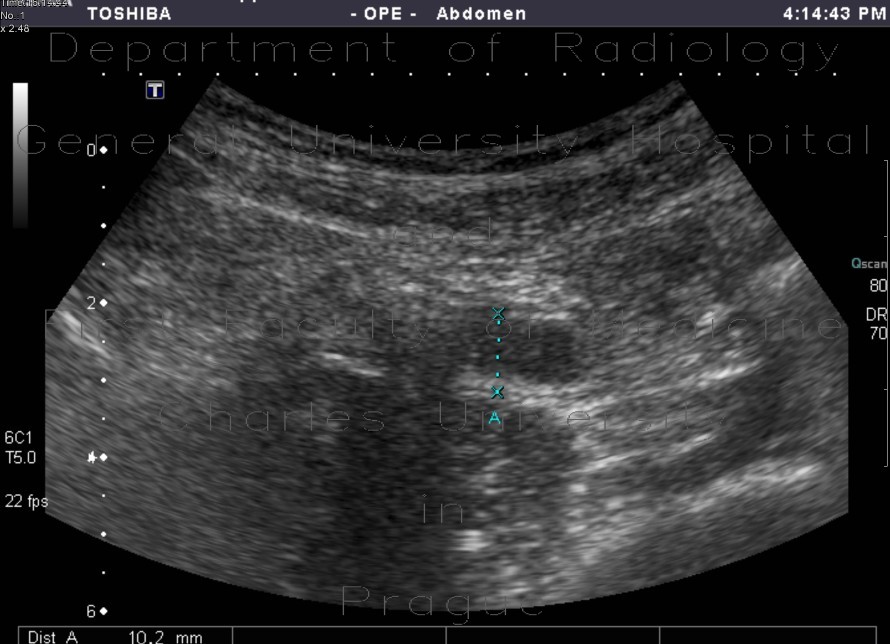 Acute appendicitis