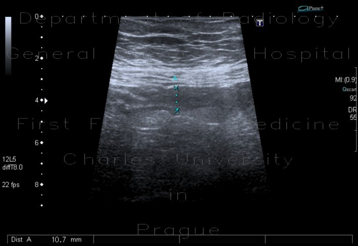 Acute appendicitis