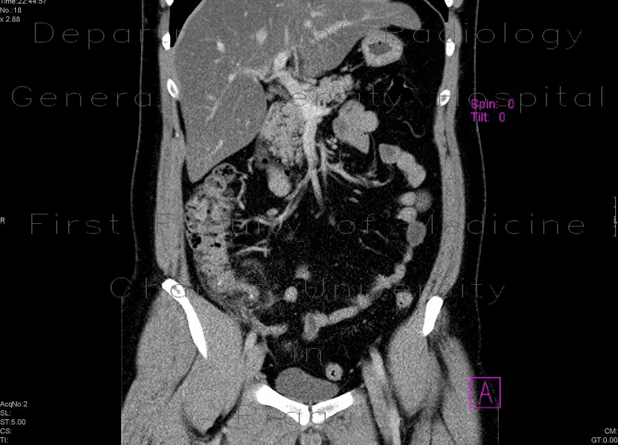 Radiology image - Acute appendicitis: Abdomen, Large bowel: CT - Computed tomography
