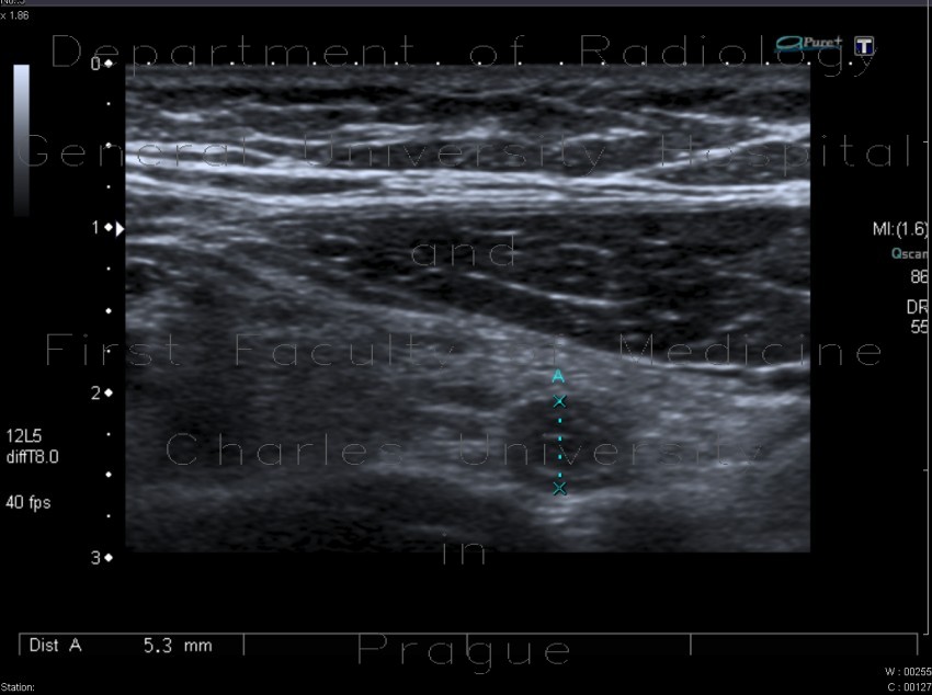 Acute appendicitis