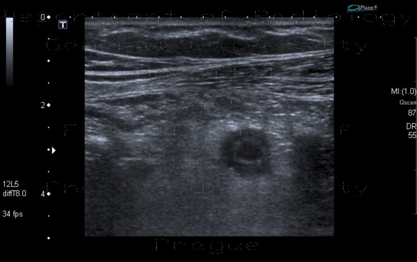Acute appendicitis