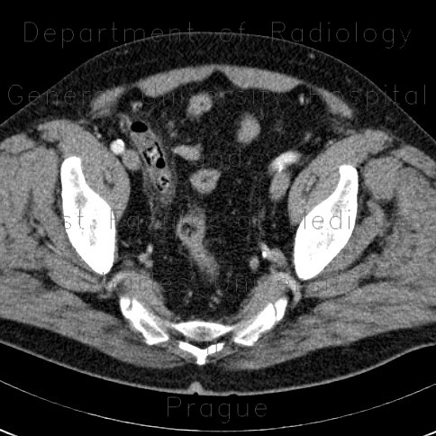 Acute appendicitis