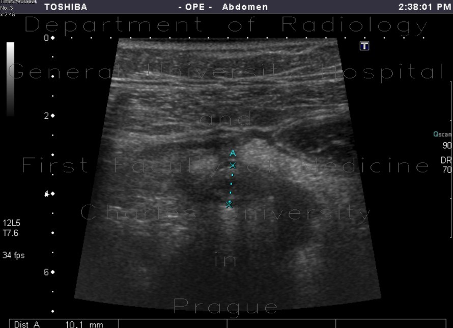 Radiology image - Acute appendicitis: Abdomen, Large bowel: US - Ultrasound