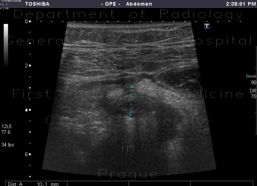 Acute appendicitis