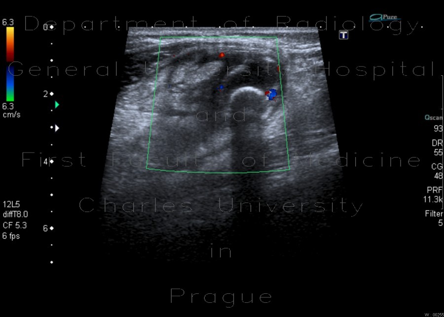 Radiology image - Acute appendicitis, fecolith: Abdomen, Large bowel: US - Ultrasound