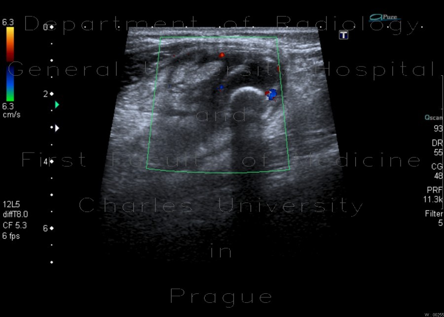 Acute appendicitis, fecolith