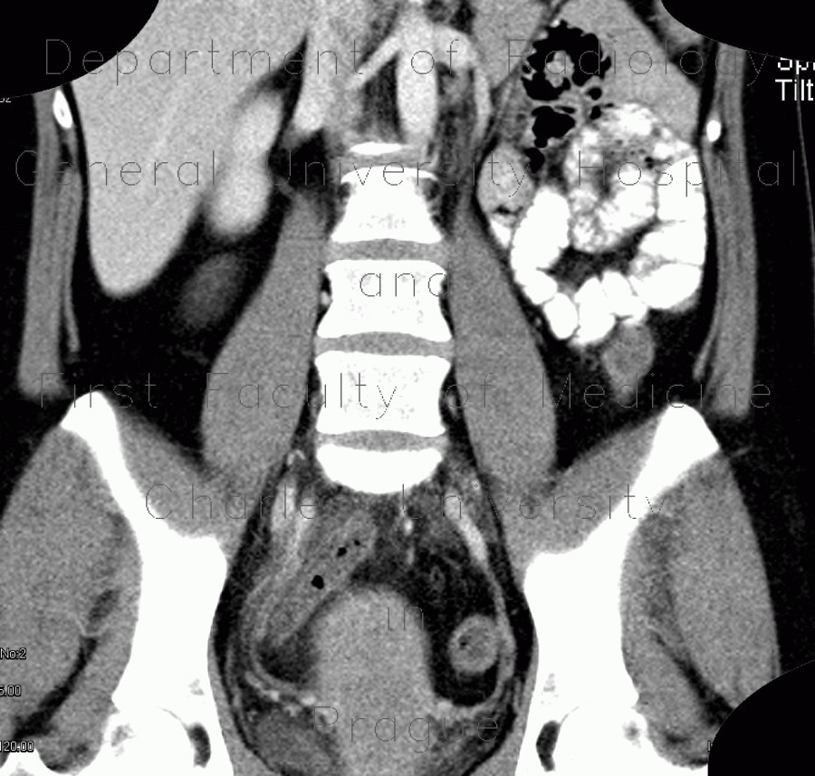 Acute appendicitis, pelvic position