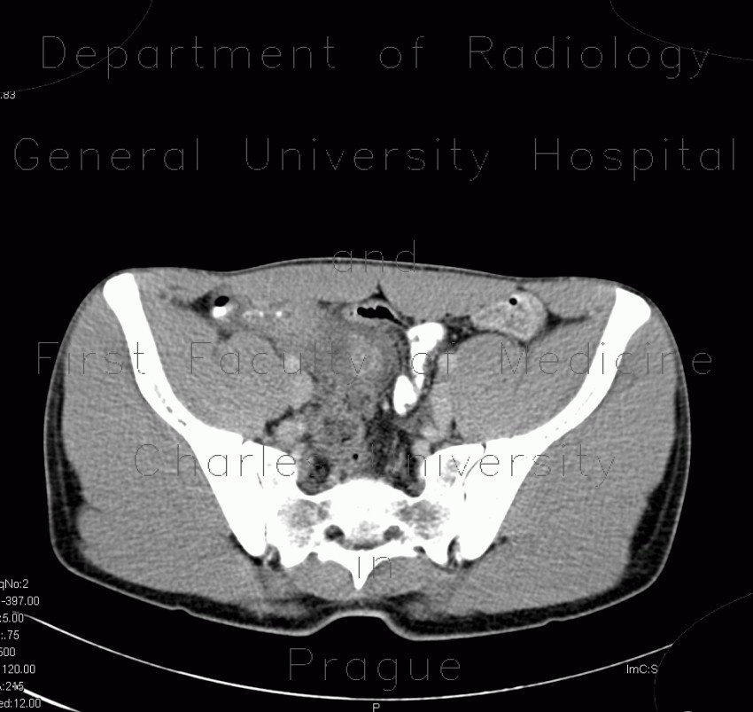 Radiology image - Acute appendicitis, periappendiceal infiltrate: Abdomen, Large bowel: CT - Computed tomography