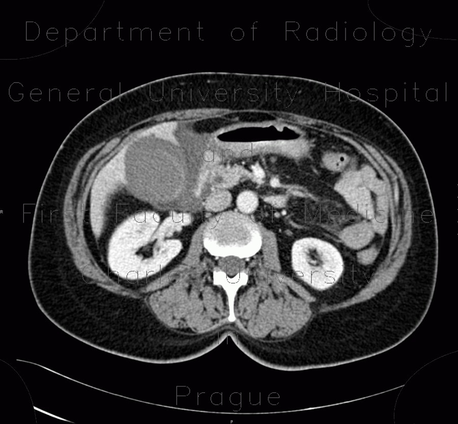 Acute cholecystitis on CT