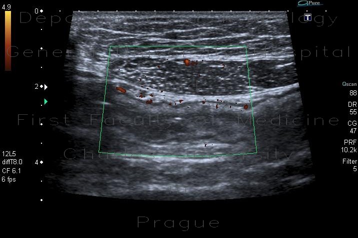 Acute colitis, inflammatory lymph nodes