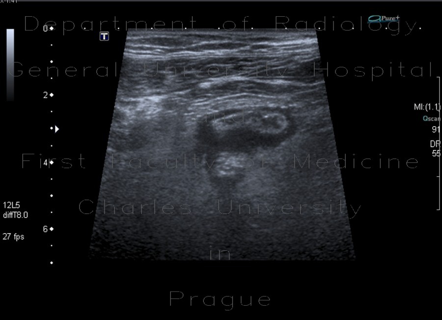 Radiology image - Acute diverticulitis on ultrasound: Abdomen, Large bowel: US - Ultrasound