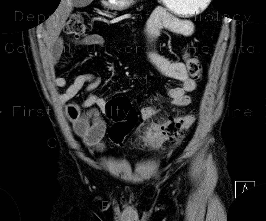 Acute diverticulitis, perforation, peritonitis, pneumoperitoneum