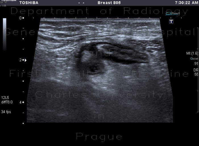 Radiology image - Acute diverticulitis, peridiverticulitis, sigmoid colon: Abdomen, Large bowel: US - Ultrasound
