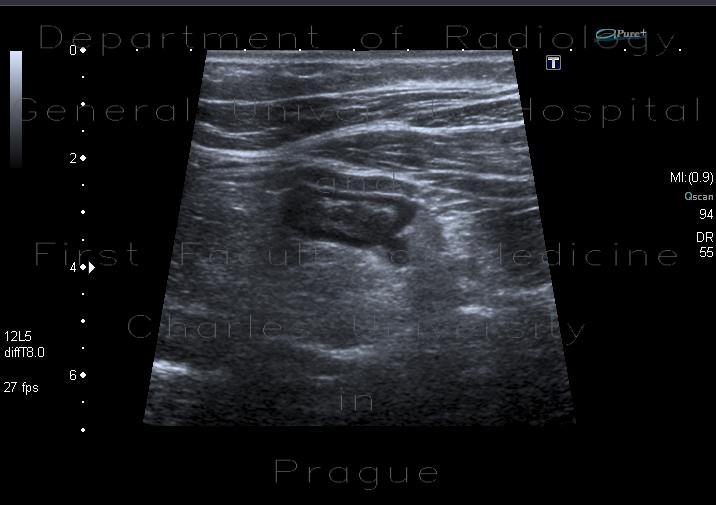 Acute diverticulitis, sigmoid colon