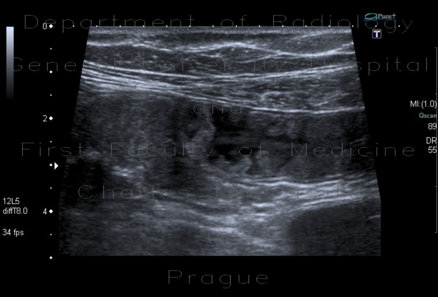 Acute enteritis, enteritis, edema of the valvulae conniventes