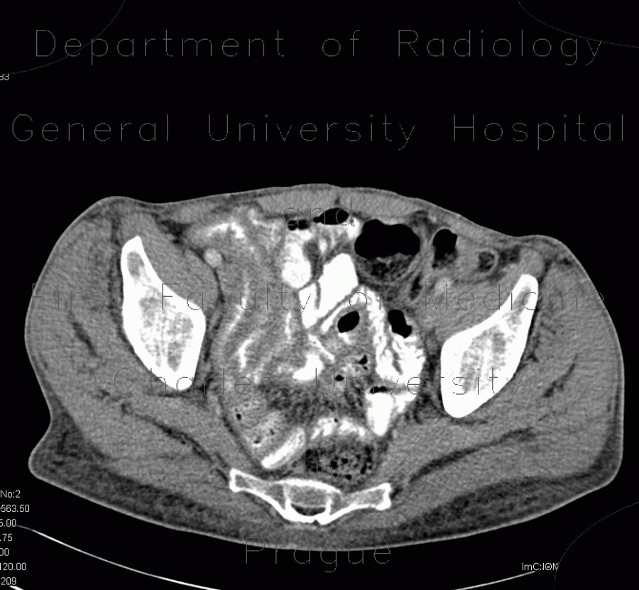 Radiology image - Acute enterocolitis, enteritis and colitis: Abdomen, Large bowel, Small bowel: CT - Computed tomography