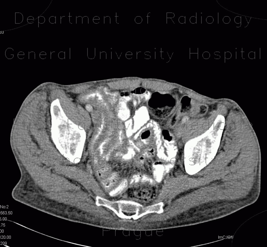 Acute enterocolitis, enteritis and colitis