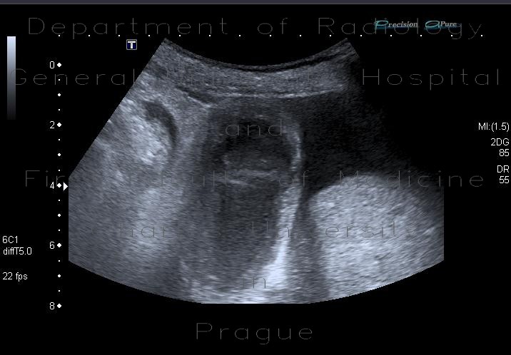 Radiology image - Acute gangrenous cholecystitis: Abdomen, Biliary tree: US - Ultrasound