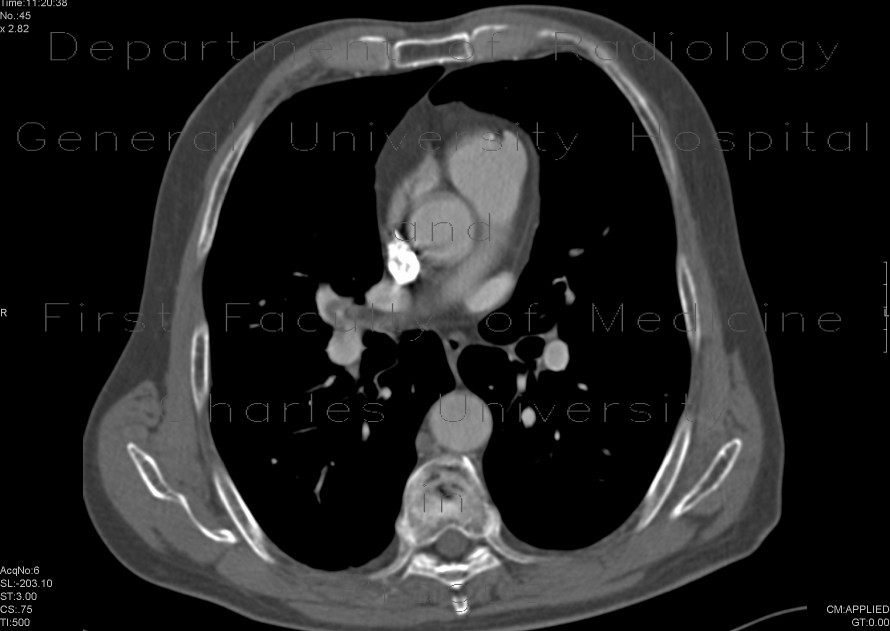 Acute lung embolism