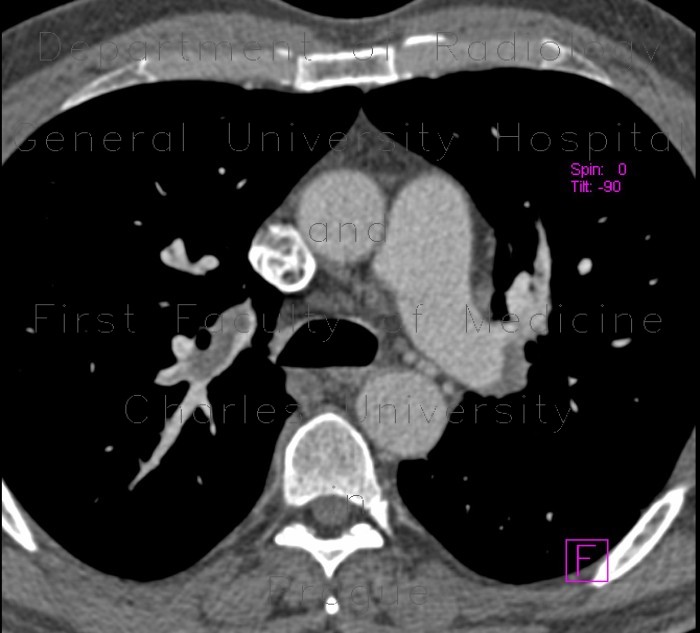 Radiology image - Acute lung embolism, massive: Thorax, Lung, Vessels: CT - Computed tomography