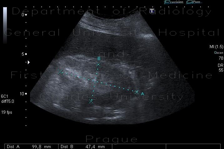 Radiology image - Acute nephritis: Abdomen, Kidney and adrenals: US - Ultrasound