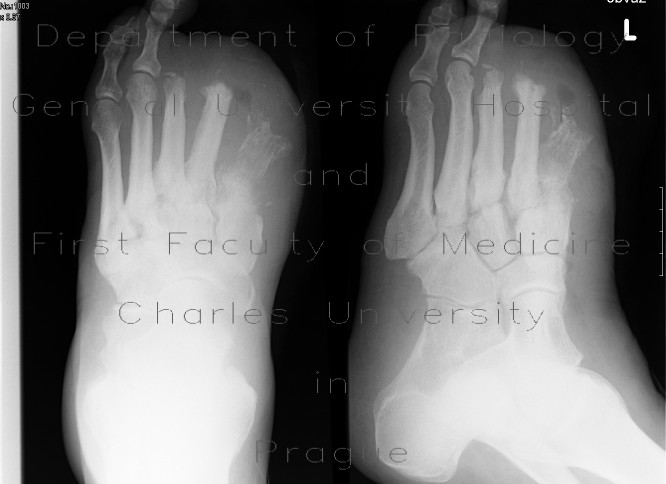 Acute osteomyelitis of the foot